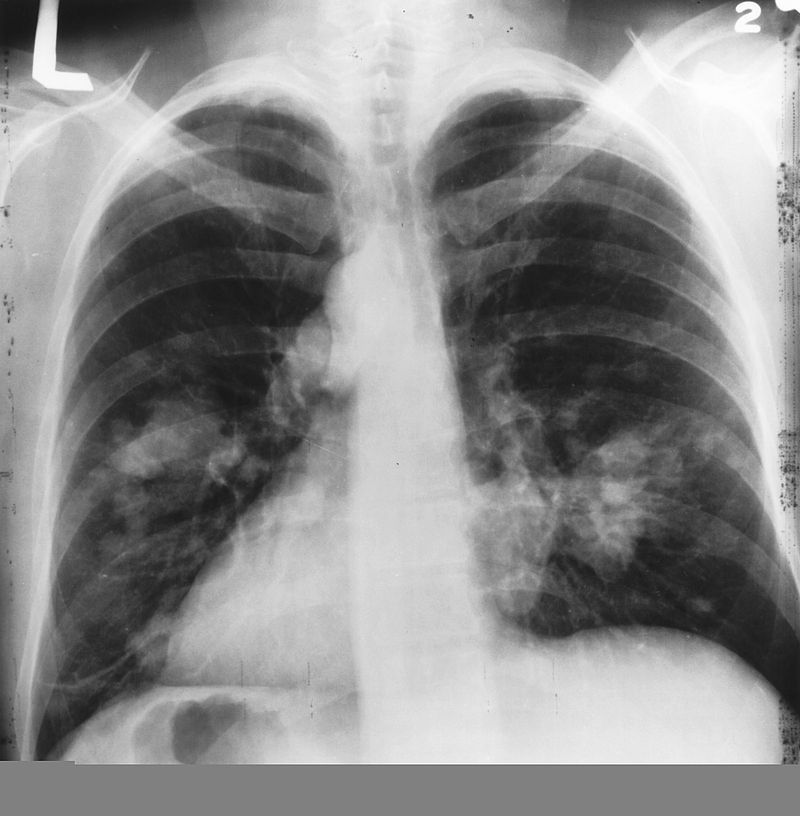 800px-X-ray(Chest)Cancer