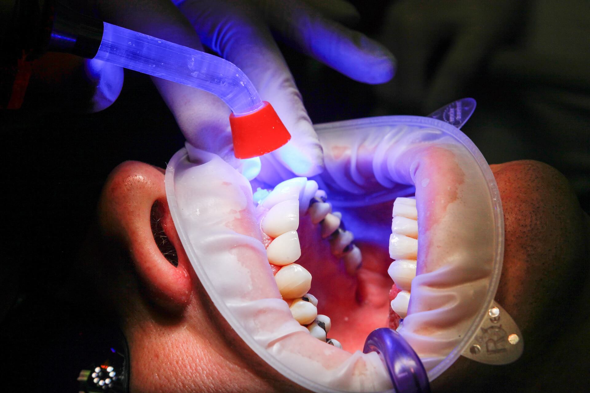 Synchrotron light makes teeth whitening treatments faster and safer