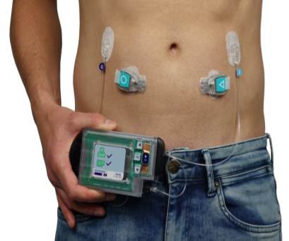 Artificial pancreas from Dutch Inreda Diabetic likely to be on the market in 2024