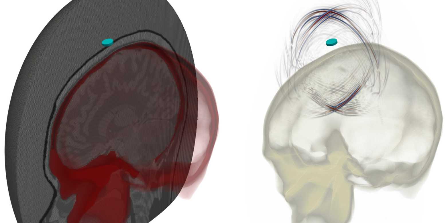 Nieuwe technologie gebruikt ultrasound om hersenen beter in beeld te brengen