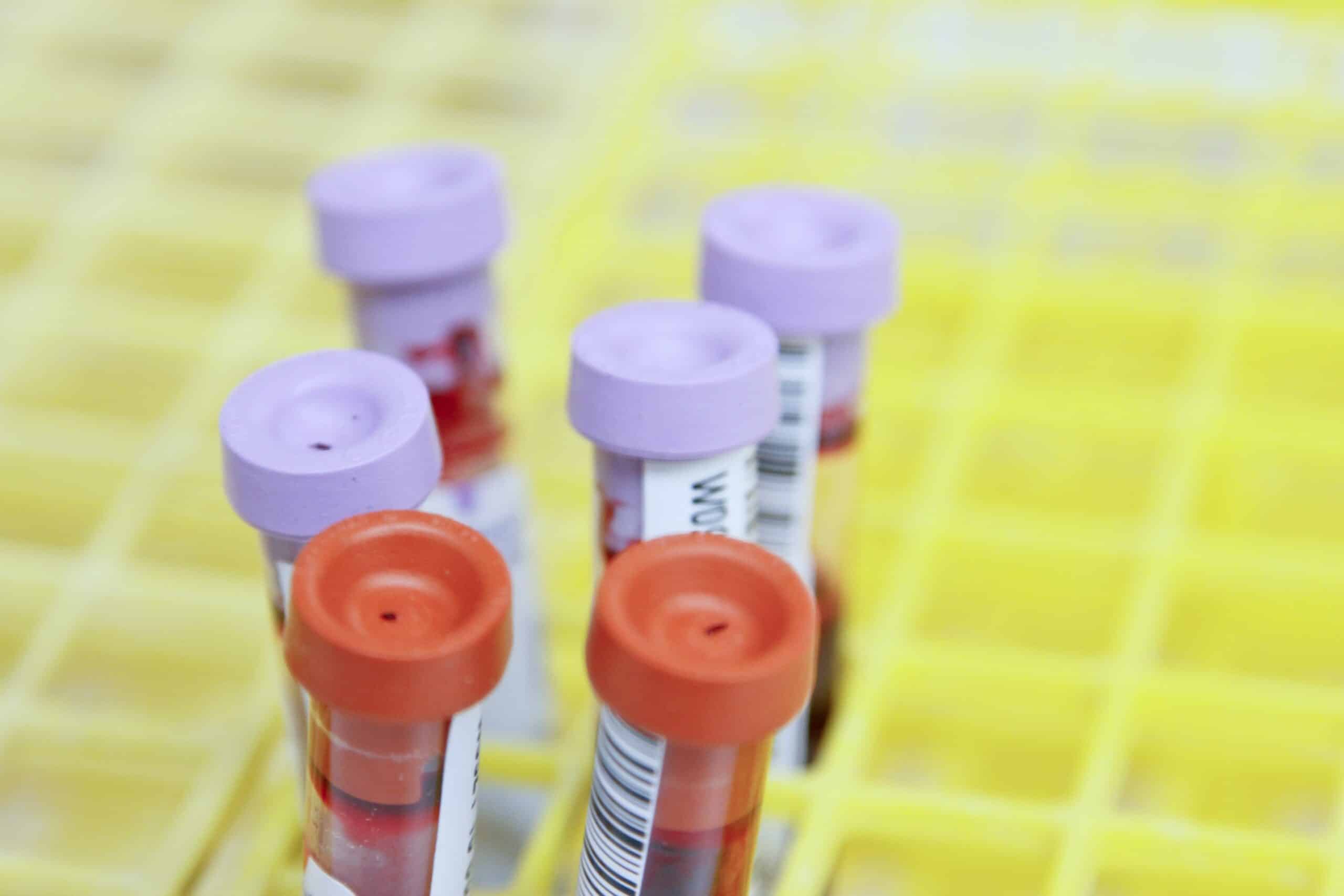 Molecular test speeds up colon cancer diagnosis